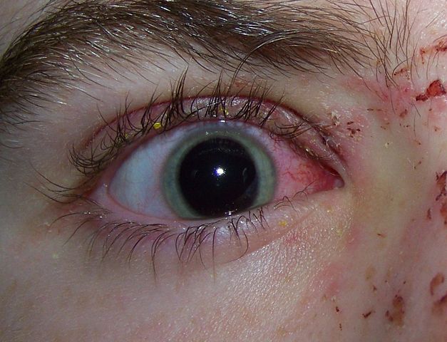 File:Eye Injury.jpg